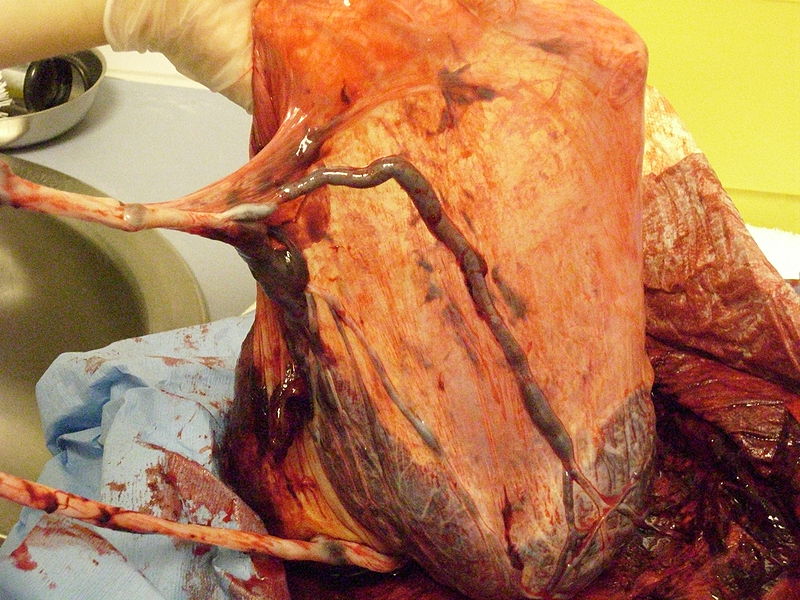 velamentous umbilical cord insertion