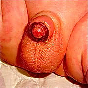 180px-plastibell_circumcision_device 180px-plastibell_circumcision_device